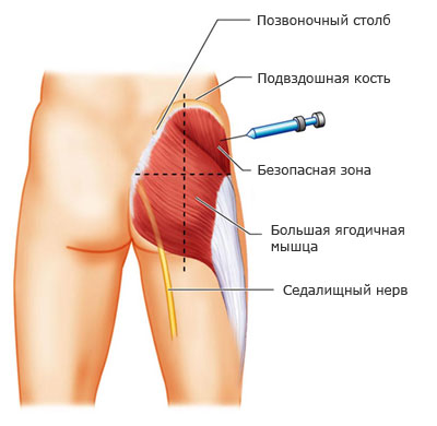 Как делать укол в ягодицу